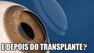 Como é VIVER com CERATOCONE depois de um TRANSPLANTE de CÓRNEA