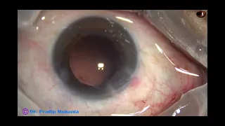 Unedited surgery - Phaco of an Intumescent Cataract - Pradip Mohanta, 17th May, 2024