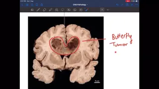 Pathology- CNS Tumors with important questions