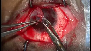 Corneal Dissection or SLET Scissors