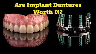 Denture FAQs - Types of Implant Dentures (Snap-On Dentures)