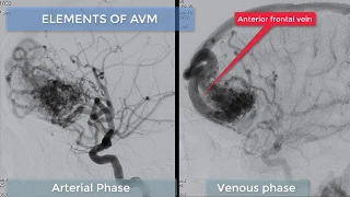 Right lateral frontal AVM embolization