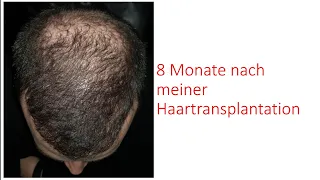 8 Monate nach der Haartransplantation | Istanbul Dr. Serkan Aygin Clinic