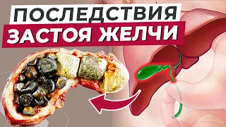 ЭТИ ПРИЗНАКИ говорят о застоях желчи! / Чем грозит застой желчи?