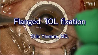 Flanged IOL Fixation Technique | Advanced IOL Fixation Techniques, edited by David F. Chang, MD