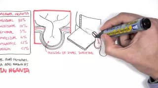 Introduction to Direct and Indirect Inguinal Hernia