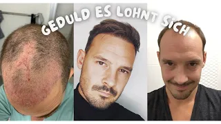 Die Höhen und Tiefen nach einer Haartransplantation.