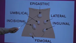 Types of Hernia