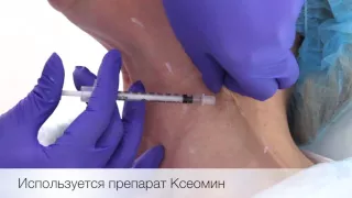 Коррекция возрастных изменений шеи  в NEO-Clinic