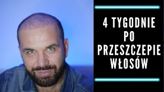 Przeszczep włosów w Turcji  - 4 tygodnie po zabiegu.