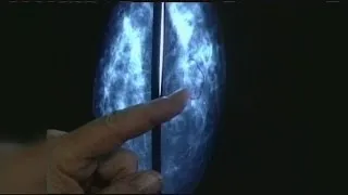 Breast cancer screening controversy