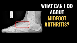 What to do about foot arthritis in the middle of your foot?