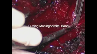 Orbitopterional (modified OZ, cranioorbital) craniotomy +clinoidectomy for tumor resection