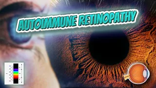 Autoimmune retinopathy - Your EYEBALLS - EYNTK 👁️💉😳💊🔊💯✅