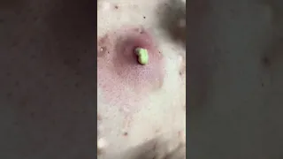 Satisfying pimple pop 💉