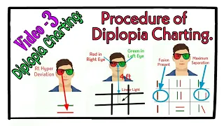 Procedure of Diplopia Charting (Diplopia Charting: Video-3)