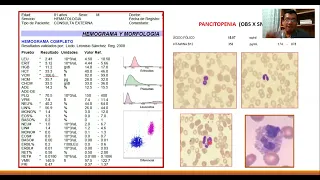 CASOS: ANEMIAS MACROCÍTICAS NO MEGALOBLÁSTICAS