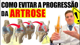 Aula 3- Como evitar a progressão da Artrose