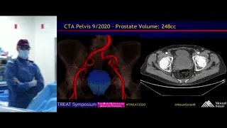 Transradial Prostate Artery Embolization (PAE) for Symptomatic BPH