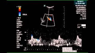 Renal Artery Doppler - Case Study