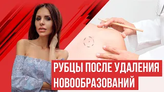 Лечение рубцов после удаления новообразований