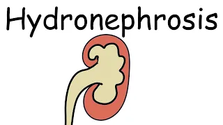What is Hydronephrosis? Causes, Presentation, Complications and Treatment - Pathology mini tutorials