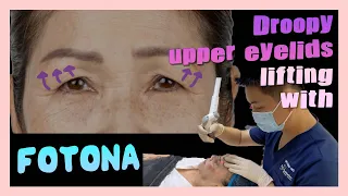 Non-surgical Upper Eyelids lifting with 【FOTONA DP】｜DR D AESTHETICS CLINIC SINGAPORE