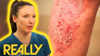 "It's Everywhere!" Woman With Severe Psoriasis Constantly Picks At Her Skin | The Bad Skin Clinic