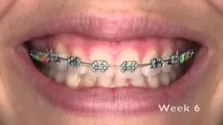 Emily's 10 weeks in braces