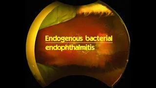 Endogenous bacterial endophthalmitis #KanskiSeries #2022