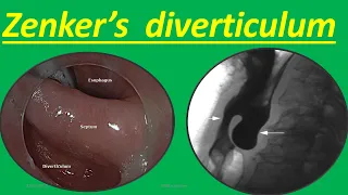 Zenker's diverticulum Symptoms, Causes, Diagnosis, Treatment, Complications and How it Occur