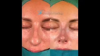 Nose Tip Surgery | Closed Rhinoplasty