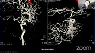 Cavernous Sinus Surgeryin symptomatic intra-cavernous aneurysm clipping -  Chih-Hsiang Liao MD, PhD