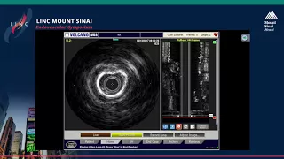 Live Case Presentation #2 COMPLEX FEMORAL ARTERY STENOSIS