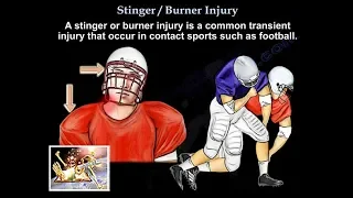 Stinger Burner Injury - Everything You Need To Know - Dr. Nabil Ebraheim