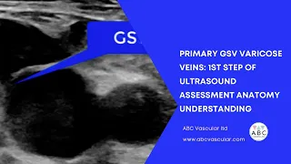 Varicose veins ultrasound assessment: GSV anatomy assessment