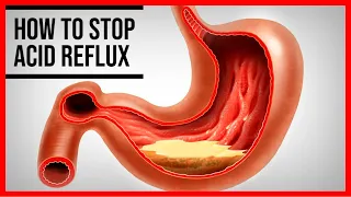 3 Home Remedies for Acid Reflux That Really Work
