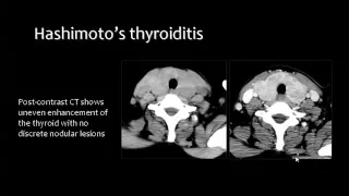 Imaging of Thyroid and parathyroid glands   Prof Dr  Mamdouh Mahfouz In Arabic 720p