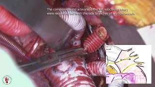 TAR thorough left thoracotomy