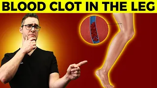 Blood Clot Symptoms & Signs [Causes & Treatment of Leg Blood Clots]