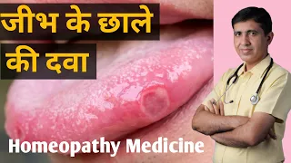 जीभ के छाले की दवा | Tongue Ulcer Treatment in Hindi | Jeebh Ke Chale ka Ilaj |Tongue Ulcer Medicine