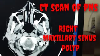 Right Maxillary Sinus Polyp || CT Scan of PNS || CT Scan of Brain || @radiographywithprasad6383