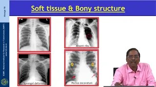 20 Radiology in diagnosis of Tuberculosis Session 01