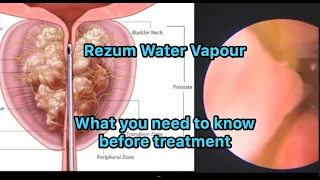 What you need to know before Rezum - Preoperative  information