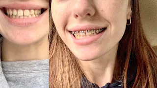 моя история брекетов // braces vlog’s