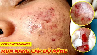 Điều trị mụn nang hiệu quả tại TPHCM| Hiền Vân Spa | Cyst Acne | 670