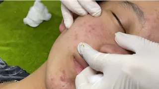 Acne treatment under the skin #017
