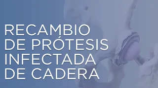 Cambio de prótesis de cadera infectada | prótesis de cadera | infección de cadera  | IQTRA