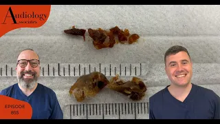 VERY FULL EAR CANAL & SATISFYING EAR WAX REMOVAL - EP855