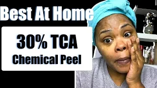 Best At Home Chemical Peel Process For Acne Scars 2019